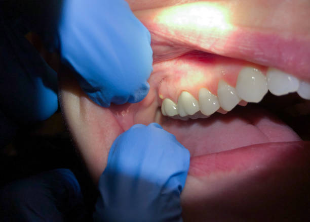 Best Urgent Dental Care for Toothache in Benson, NC