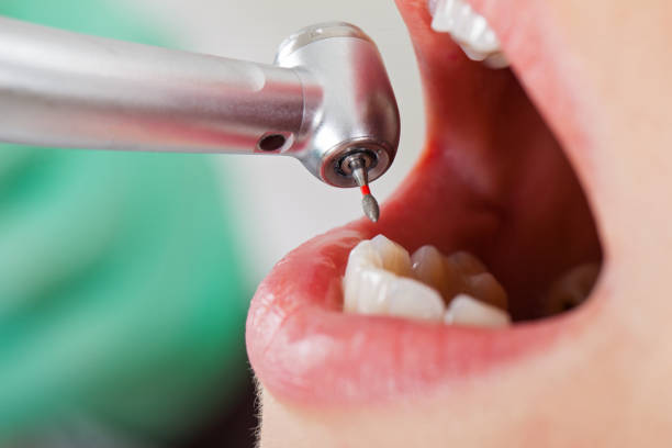 Best Broken or Cracked Tooth Emergency Dentist in Benson, NC